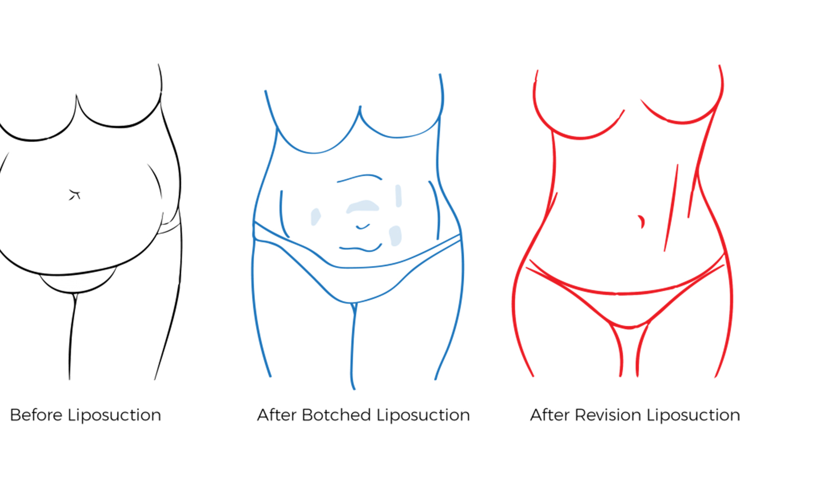 revision liposuction